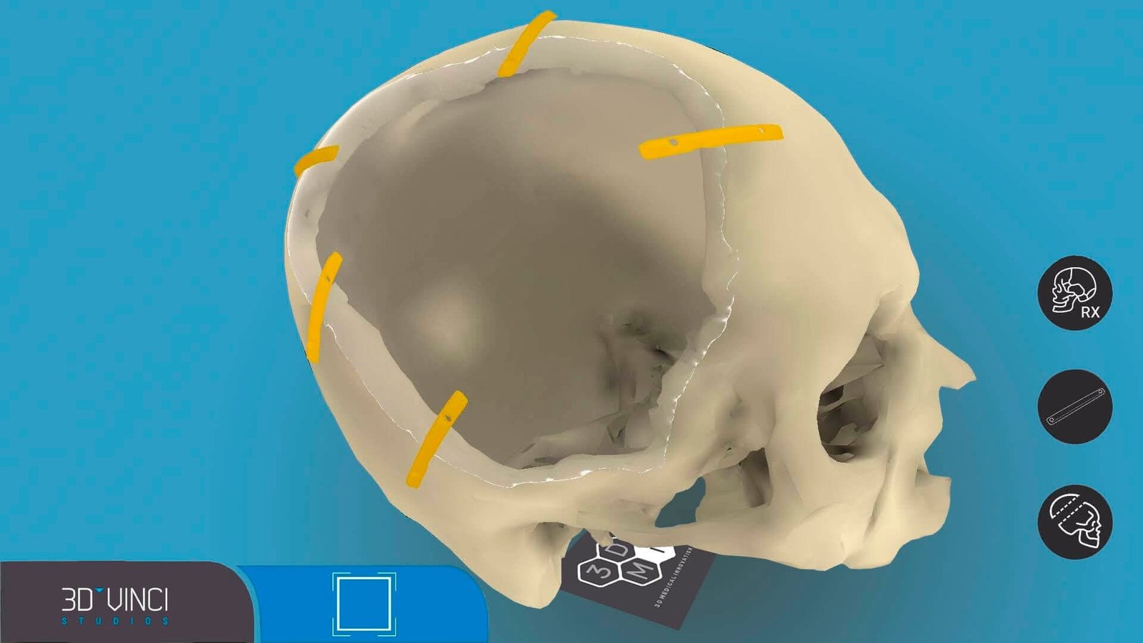 Craneo en realidad aumentada para craneoplastia